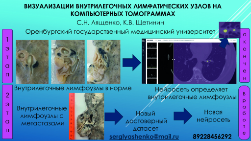 9. Визуализации внутрилегочных лимфатических узлов на компьютерных томограммах