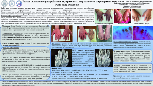 Редкое осложнение употребления внутривенных наркотических препаратов: Puffy hand syndrome.